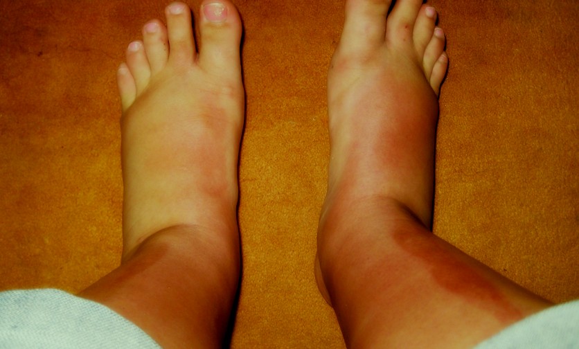 sun-poisoning-pictures-2