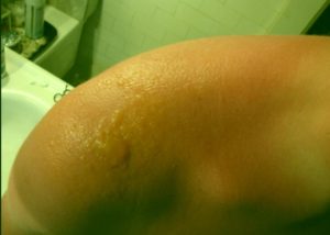 sun-poisoning-rash-pictures-1