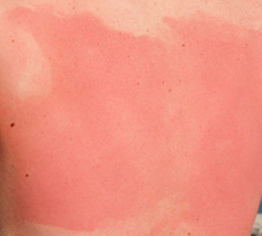 sun-poisoning-rash